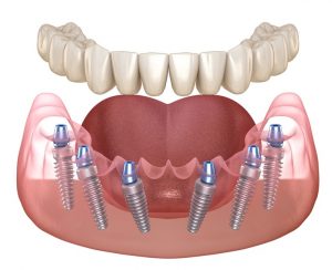 Mandibular,Prosthesis,All,On,6,System,Supported,By,Implants.,Medically